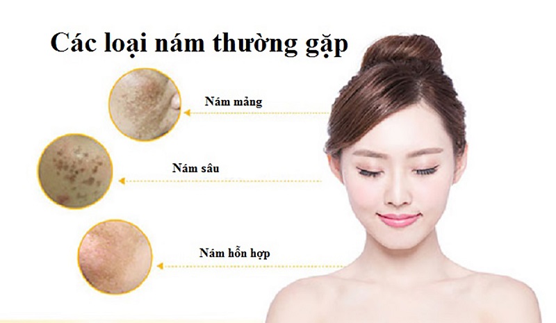 Các loại nám da thường rất khó chữa trị