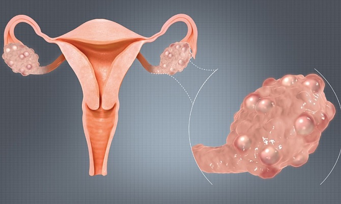 Buồng trứng đa nang là một bệnh lý phụ khoa thường xảy ra ở những chị em trong độ tuổi sinh sản