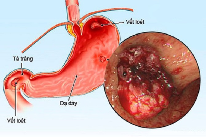 Viêm loét dạ dày là một bệnh lý đường tiêu hóa phổ biến hiện nay